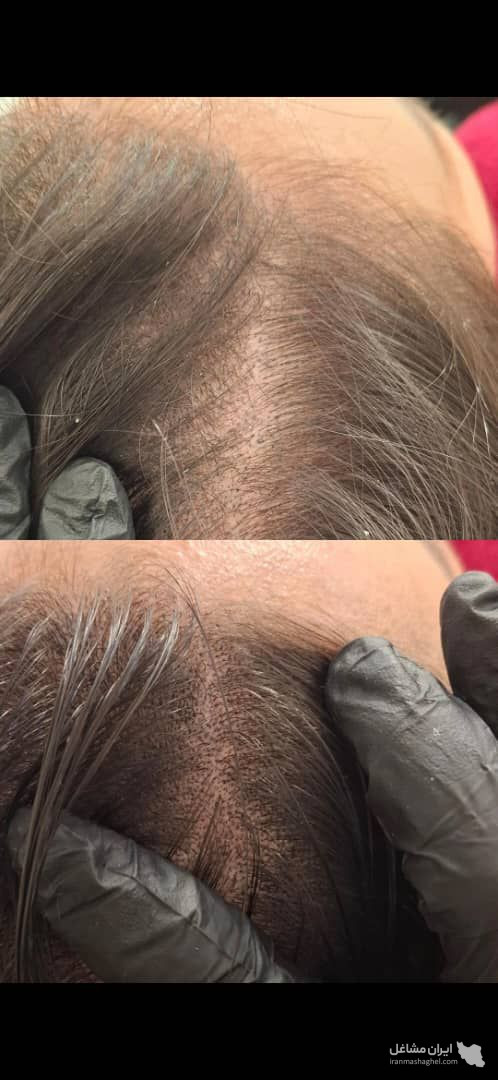 خدمات میکرواسکالپ و اسکالپ سر مریم شکری در مهرشهر کرج