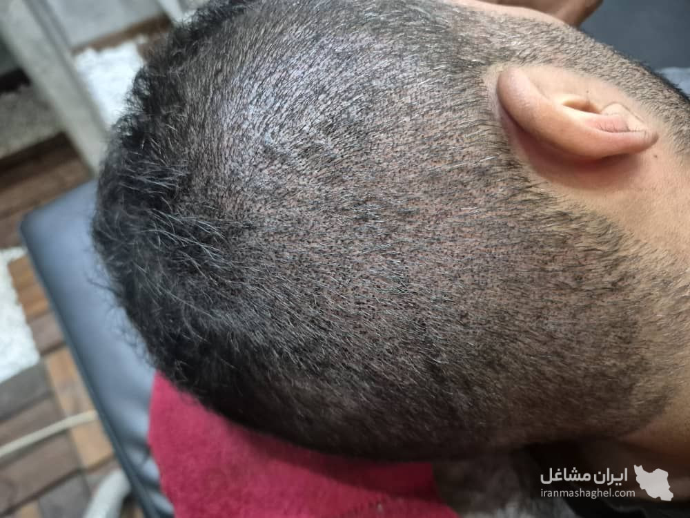 خدمات میکرواسکالپ و اسکالپ سر مریم شکری در مهرشهر کرج