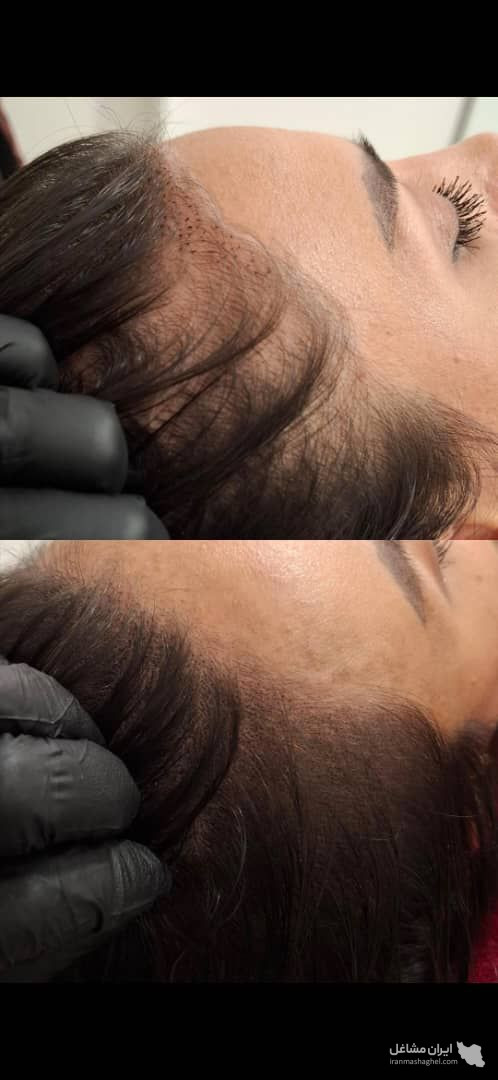 خدمات میکرواسکالپ و اسکالپ سر مریم شکری در مهرشهر کرج