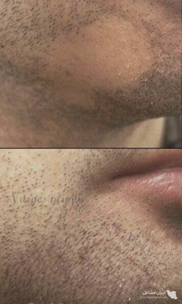 خدمات میکرواسکالپ و اسکالپ سر مریم شکری در مهرشهر کرج