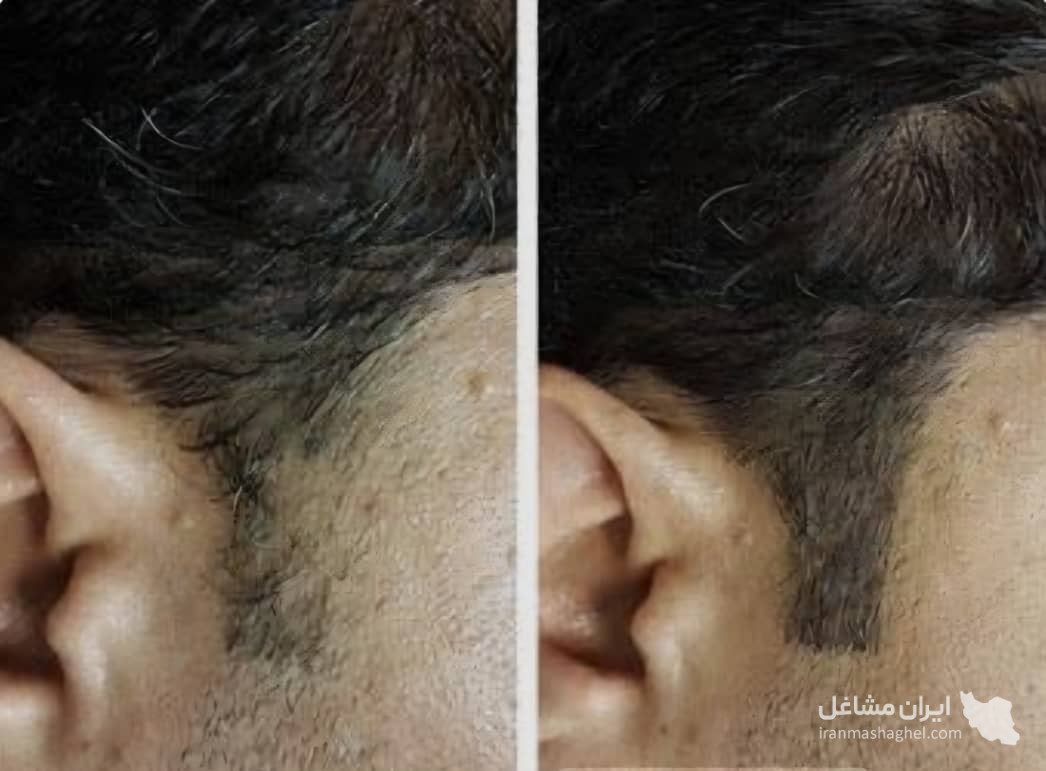 خدمات میکرواسکالپ و اسکالپ سر مریم شکری در مهرشهر کرج