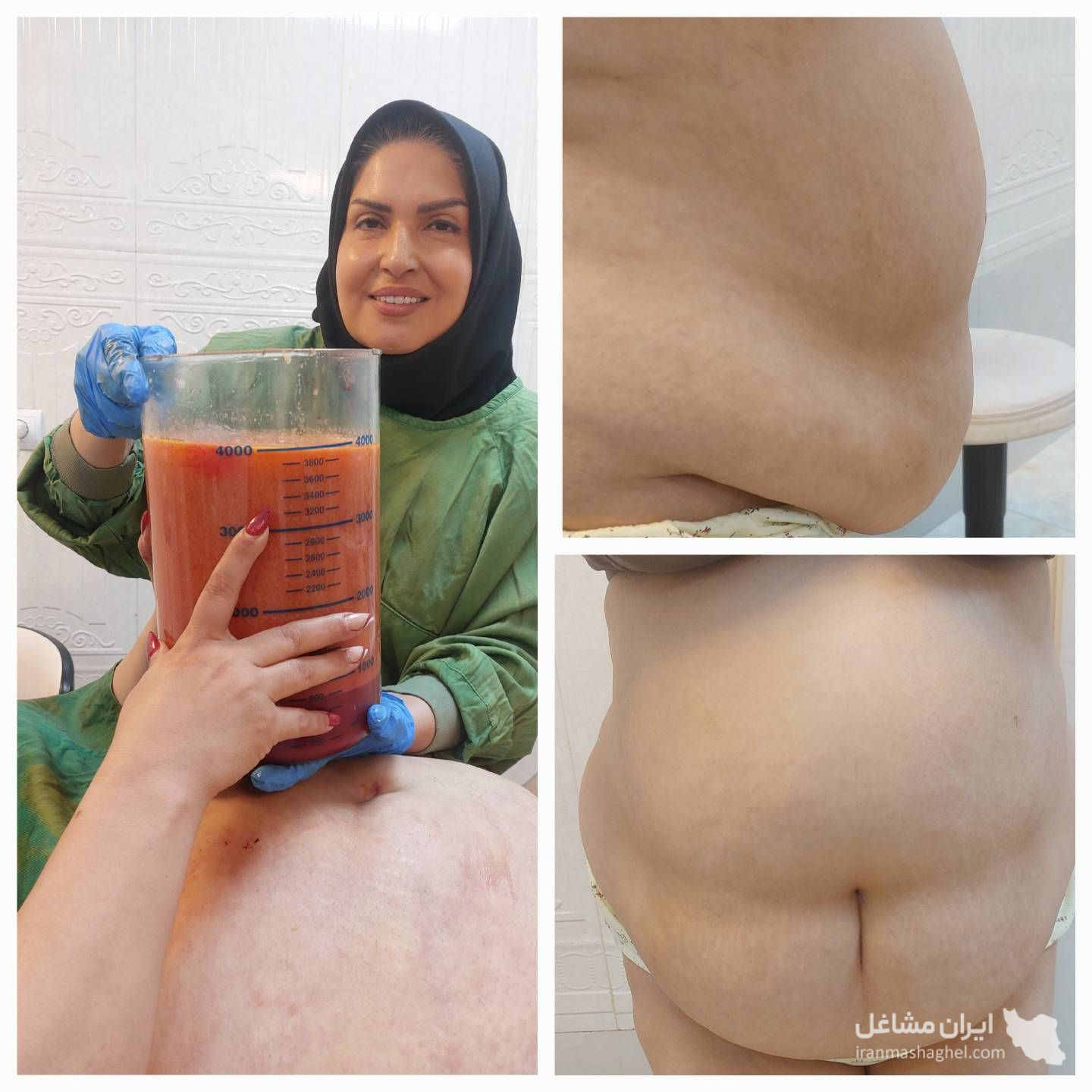 مرکز لیپوماتیک با دستگاه پال دکتر فرشته شاد در پیروزی تهران