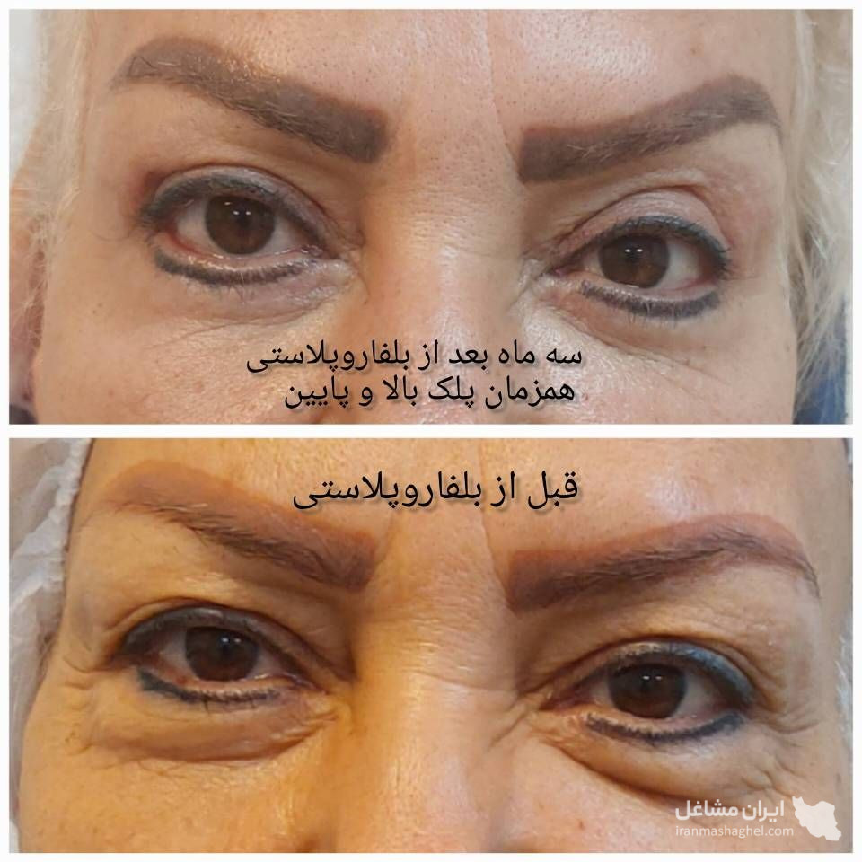 مرکز بلفاروپلاستی پلک بالا و پایین دکتر فرشته شاد در پیروزی تهران
