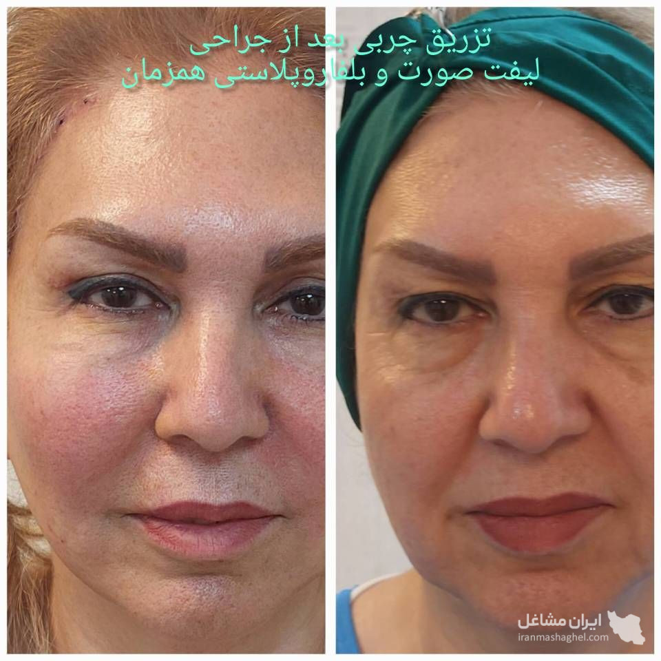 مرکز بلفاروپلاستی پلک بالا و پایین دکتر فرشته شاد در پیروزی تهران