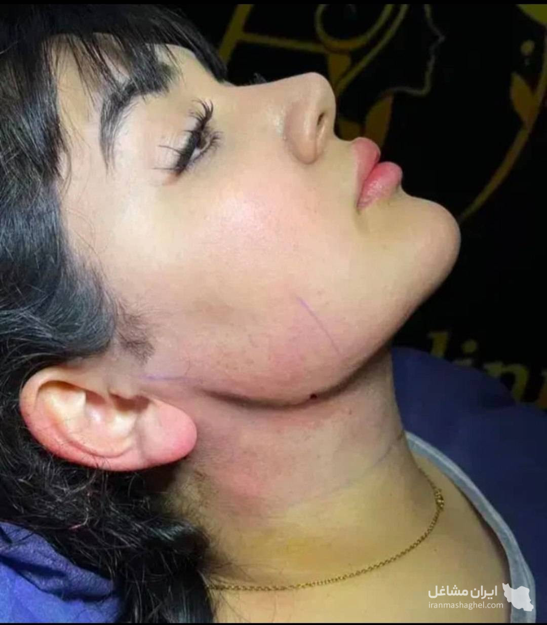 مرکز تخصصی ساکشن غبغب و بوکال فت دکتر وحید عباس نژاد در صادقیه تهران